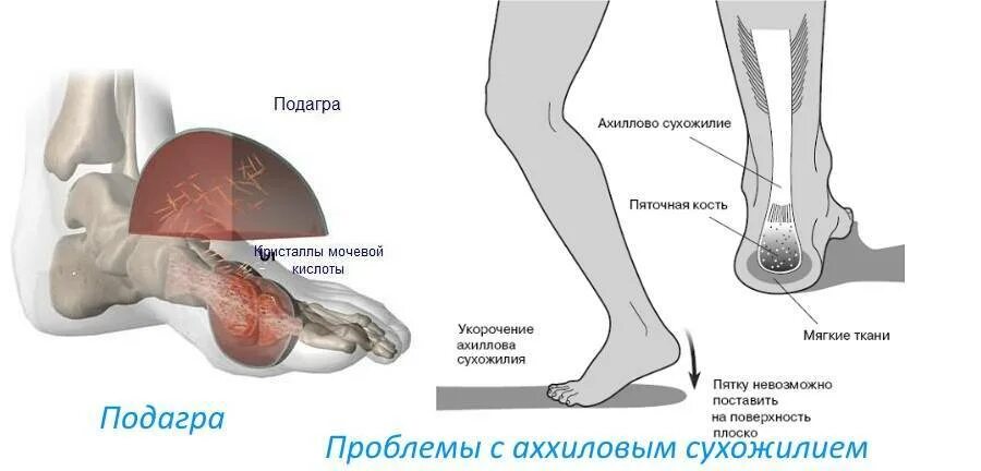 Сильные боли в пятке при ходьбе. Болят пятки ног причины.