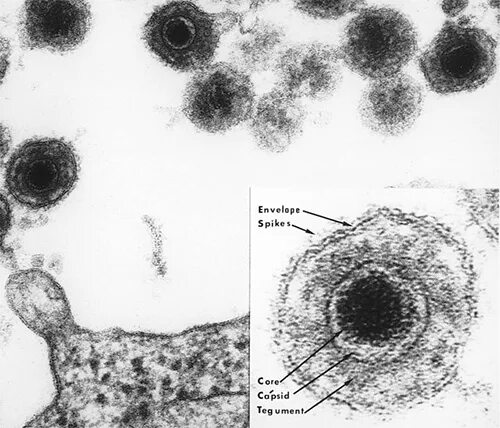 Herpes virus 6. Вирус герпеса человека 6-го типа. Вирус герпеса 6 типа патогенез. Герпесвирусная инфекция ВГЧ 6 типа.