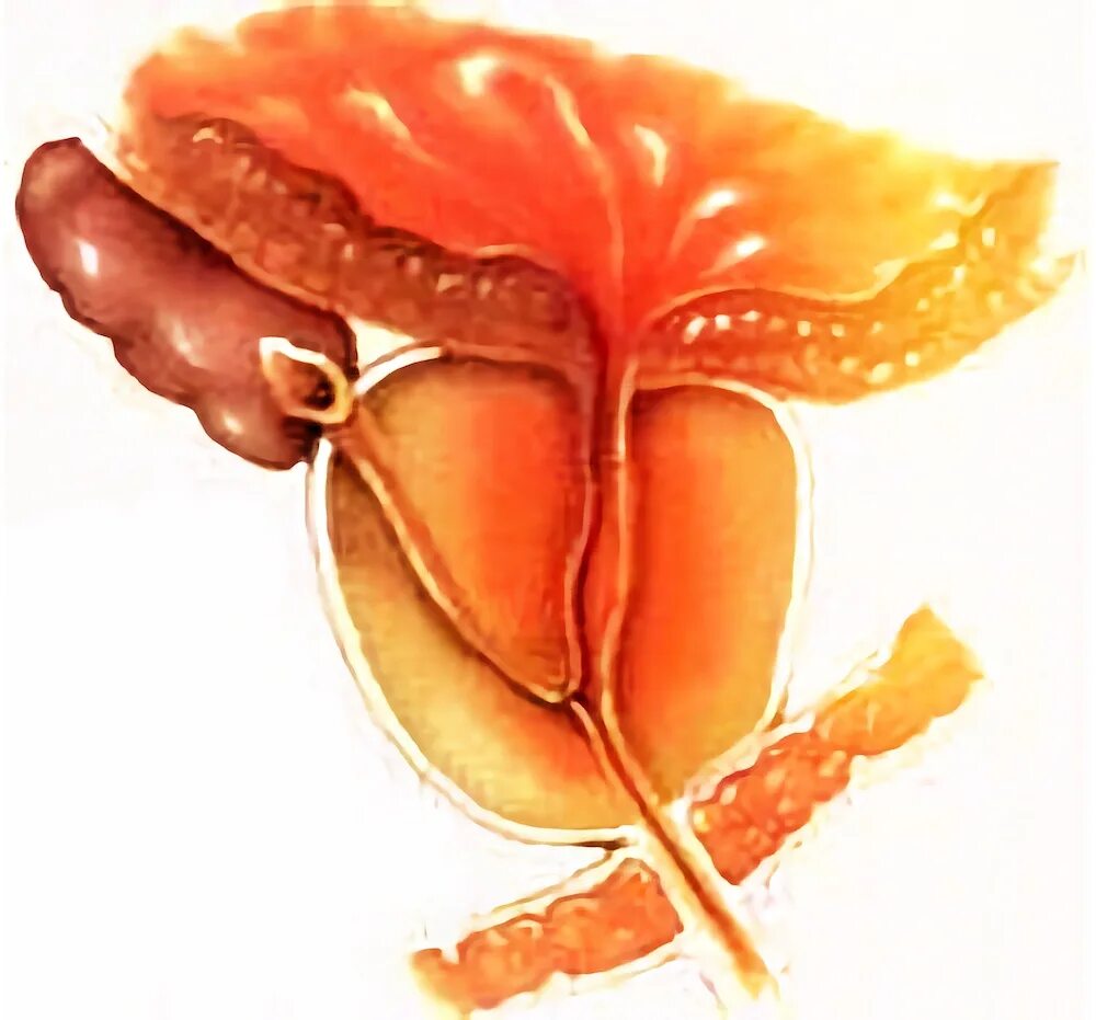 Воспаление предстательной. Воспаление в предстательной железе. Воспаление железы простаты. Нарушение предстательной железы