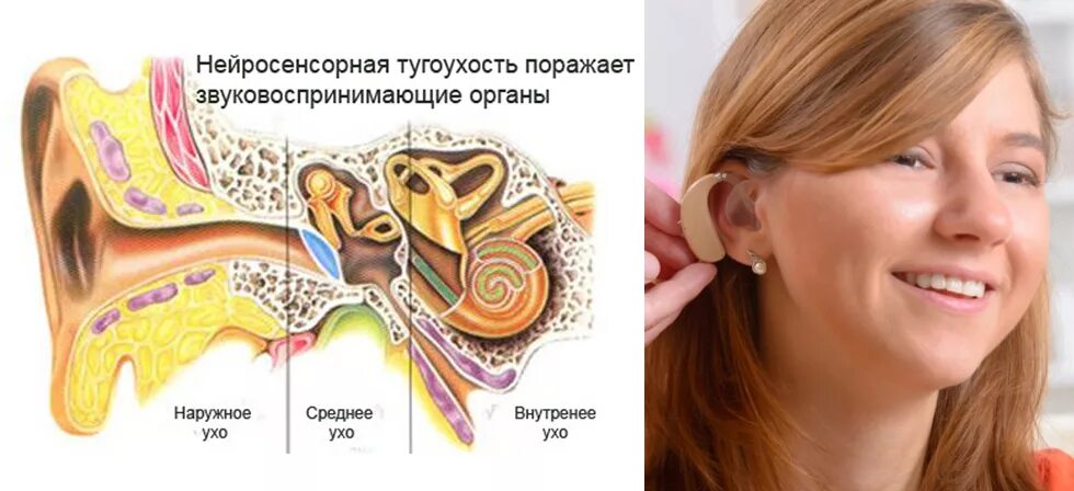 Тугоухость что это такое симптомы. Профессиональная нейросенсорная тугоухость. нейросенсорной тугоухости. неоро сеснсорная тугоухость. нейросенсор тугоухост.