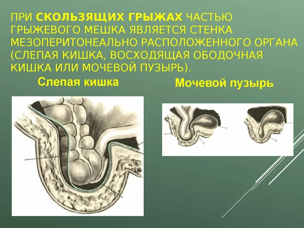 Слепая кишка стенки. Стенки грыжевого мешка. Скользящая грыжа мочевого пузыря. Скользящие грыжи слепой кишки.