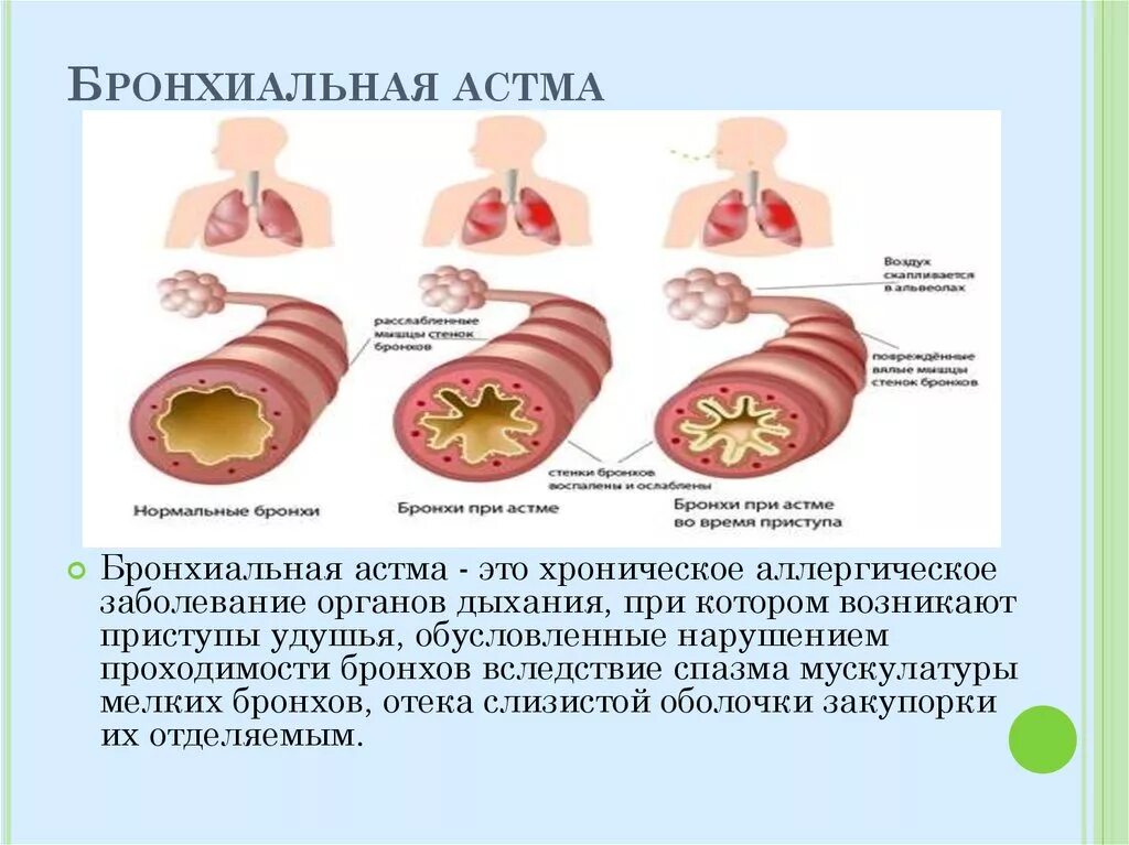 Бронхиальная астма картинки. Хроническая бронхиальная астма. Бронхиальная астма мокрота. Аллергическое заболевание дыхательных путей. Бронхиальная астма это хроническое заболевание.