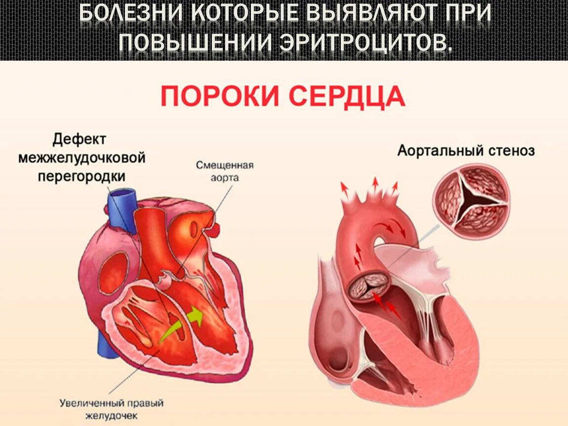 Врожденныепопроки сердца. Пороки сердца:пороки сердца.