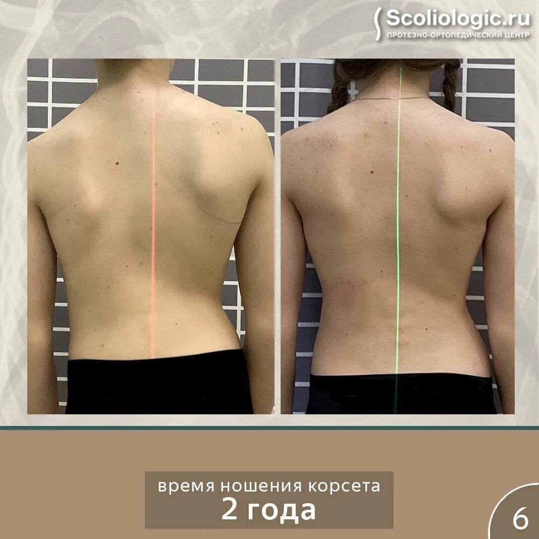 Как лечить сколиоз 1 степени у подростков. Корсет для сколиоза. корсет для позвоночника при сколиозе. небольшое искривление позвоночника. корсет шено для позвоночника.