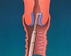 Биопсия выскабливанием. Выскабливание цервикального канала шейки. Биопсия цервикального канала. Биопсии скобление матки. Кюретка 1 выскабливание цервикального канала.
