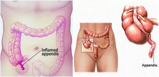 Аппендикс находится справа. Где находится аппендицит. Где находится аппендикс. Где находится аппендикс у человека.