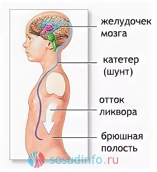 Гидроцефалия шунтирование мозга. Шунтирование головного мозга. Вентрикуло перитонеальный шунт. Шунтирование головного мозга в брюшную.