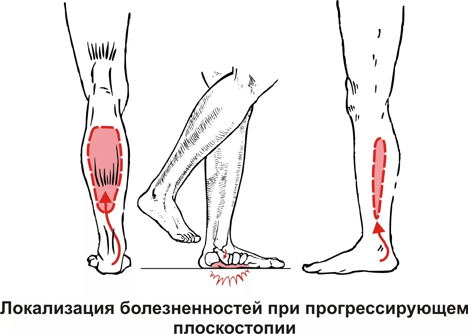 Мышцы стопы плоскостопие. Судорога икроножной мышцы. Мышцы голени при плоскостопии.