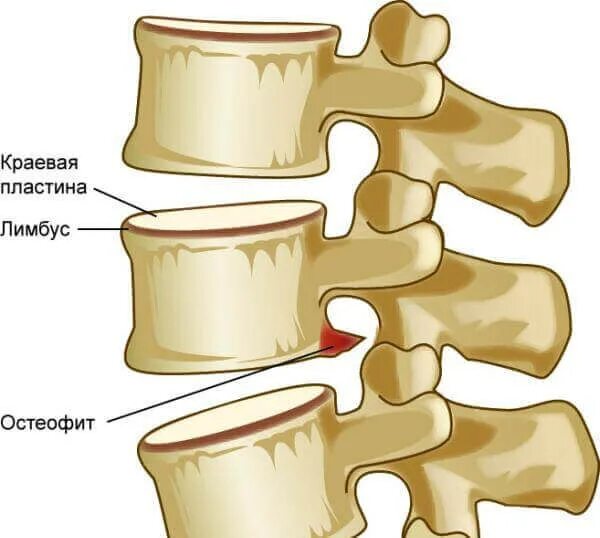 Остеофиты что это такое и как лечить. Краевые остеофиты тел позвонков поясничного отдела. Краевые остеофиты тел позвонков что это такое. Костные остеофиты l2-s1. Спондилёз грудного отдела позвоночника th7.