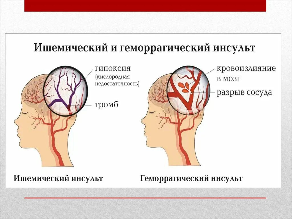 Где находится инсульт. Инсульт. Типы ишемического инсульта. Локализация ишемического инсульта.