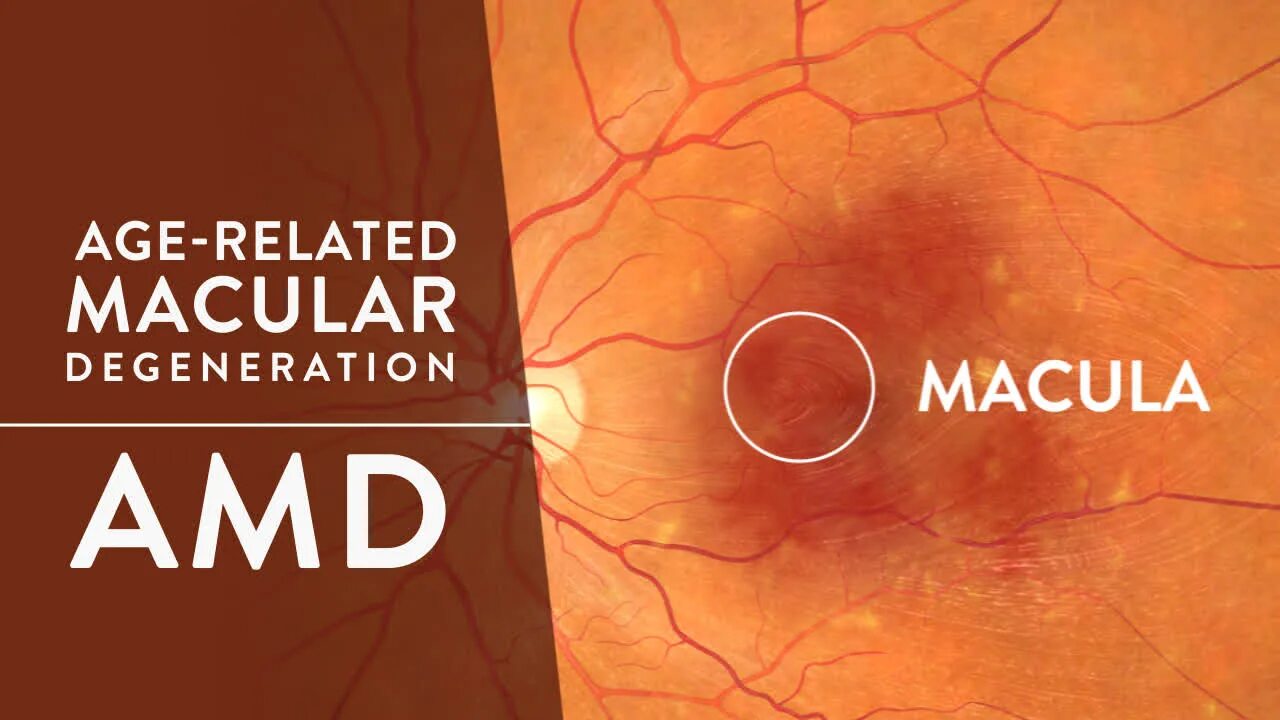 Dry and wet ARMD Macular scar.