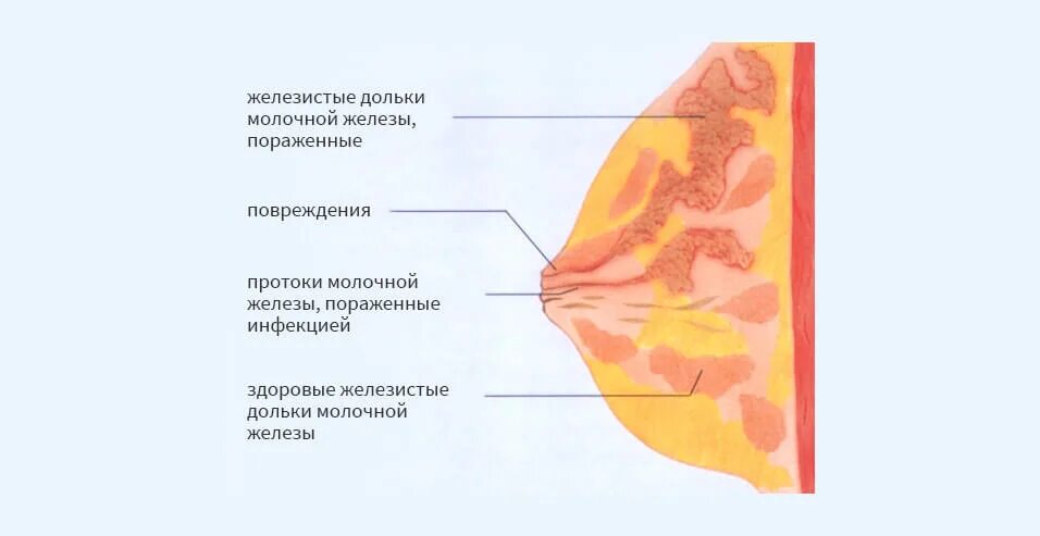 Заболевания молочной железы. Диагностика и лечение