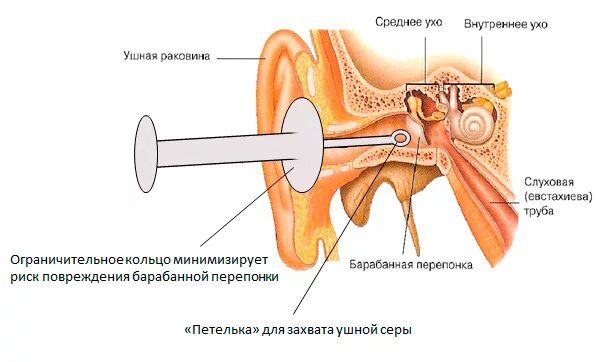 Удаление внутреннего уха. Ухо строение серная пробка. строение уха человека с серной пробкой. строение уха серная пробка. строение уха с серной пробкой.