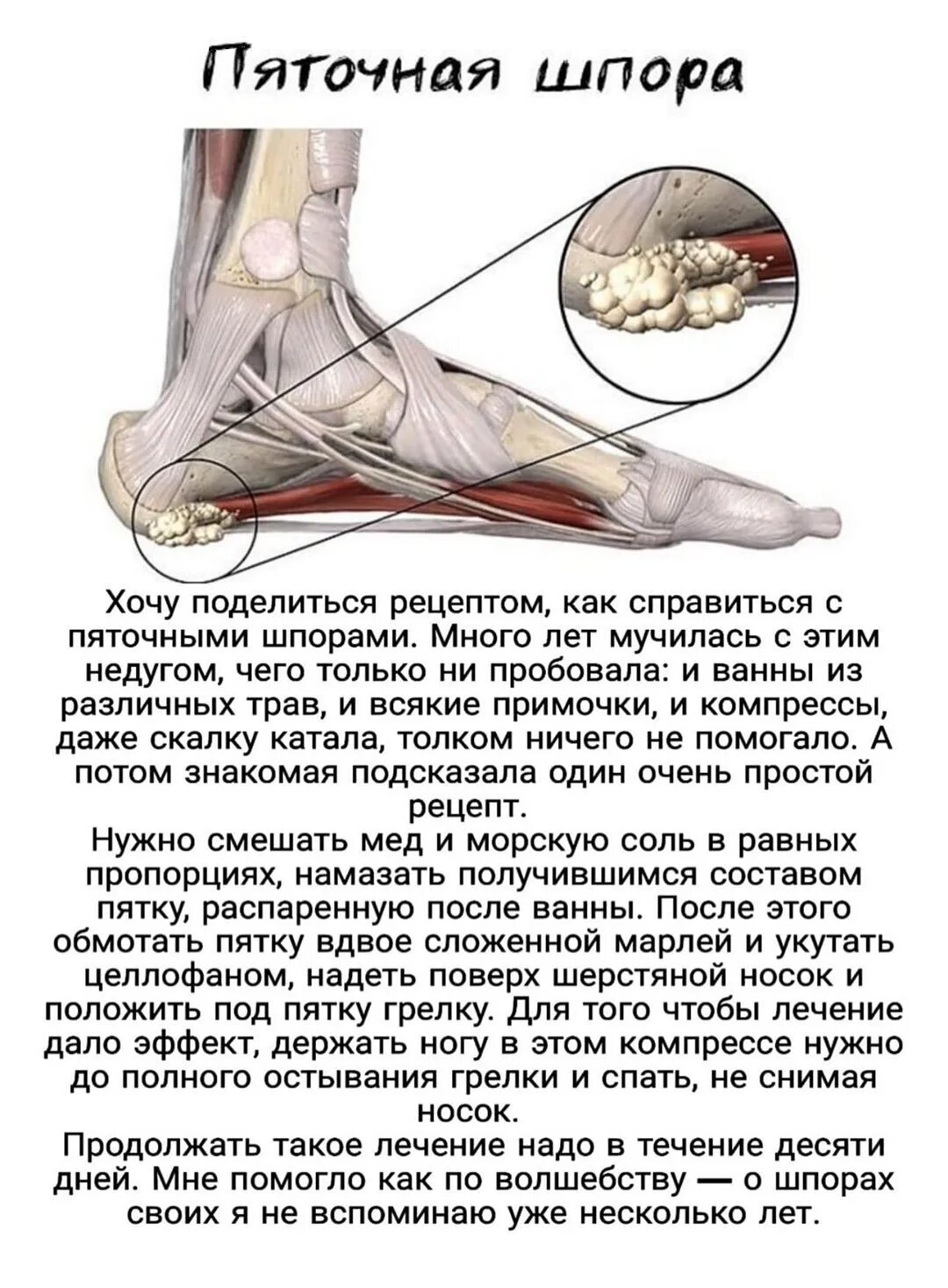 Пяточная шпора что это и как лечить