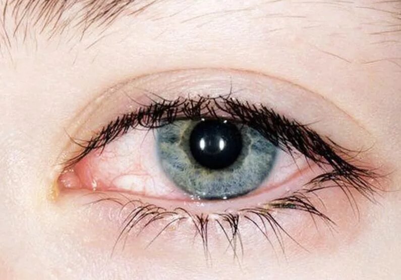 почему у ребенка красный белок глаза