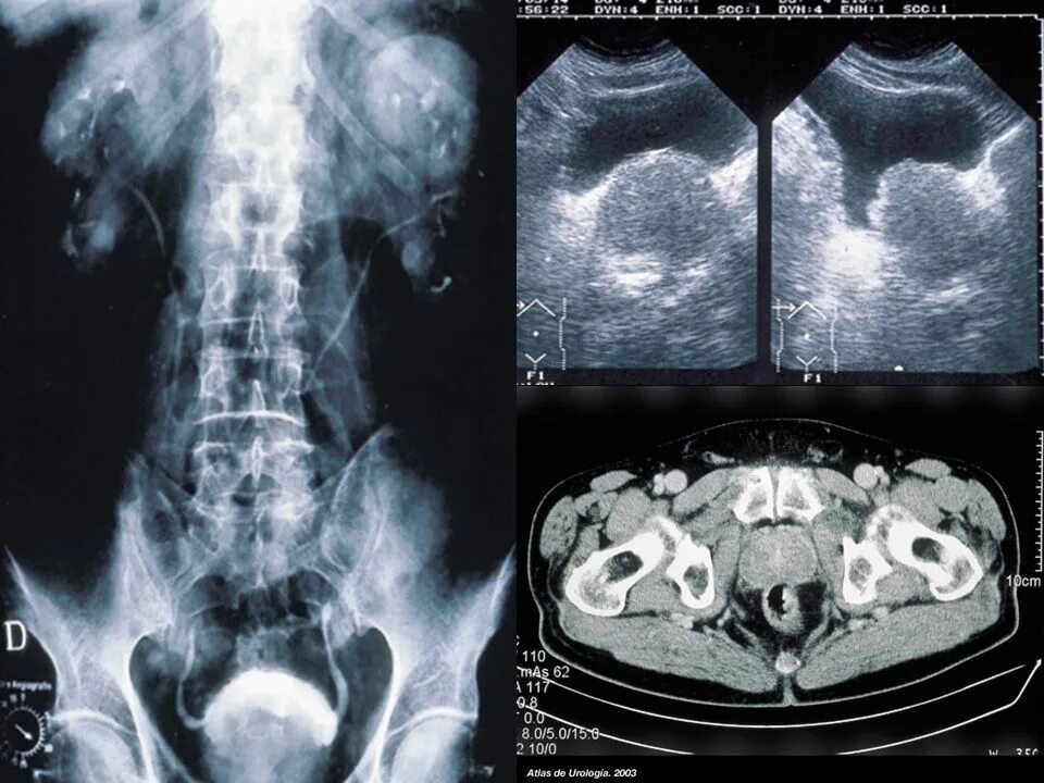 Рентген предстательной железы. Аденома предстательной железы на рентгене. Гиперплазия предстательной железы рентген. Простатоцистит