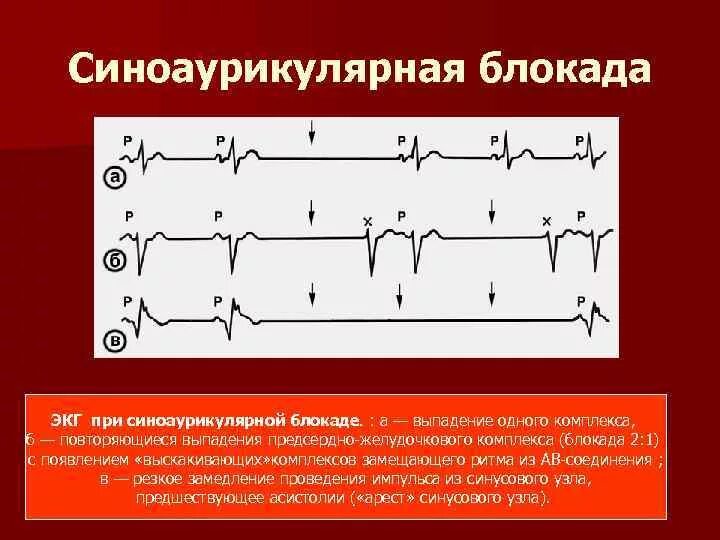 Синусно предсердная блокада на экг. Блокада атриовентрикулярного узла. Блокада синусового узла. Блокада сердца 2 степени экг. Са-блокада 2 степени 2 на экг.
