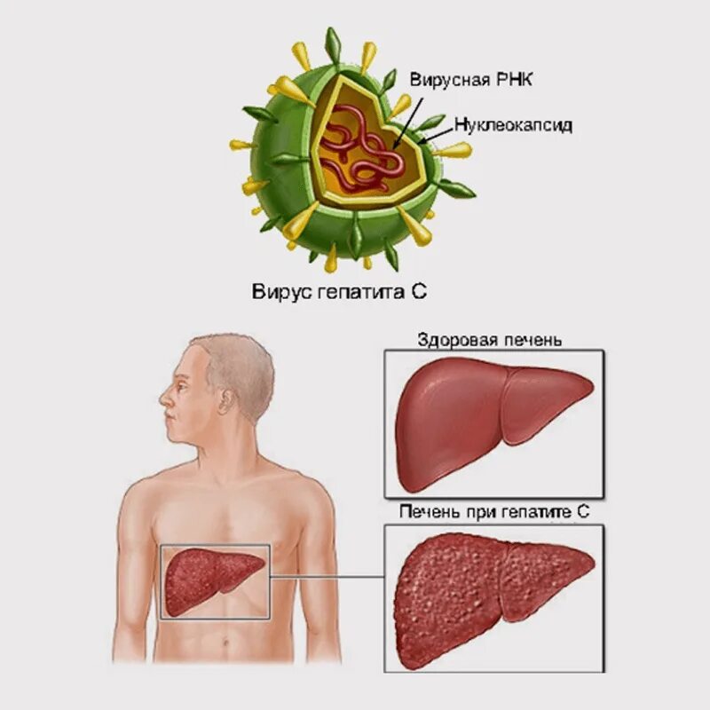Заражение гепатитом c. Вирусные гепатиты. Проявление вирусного гепатита а.