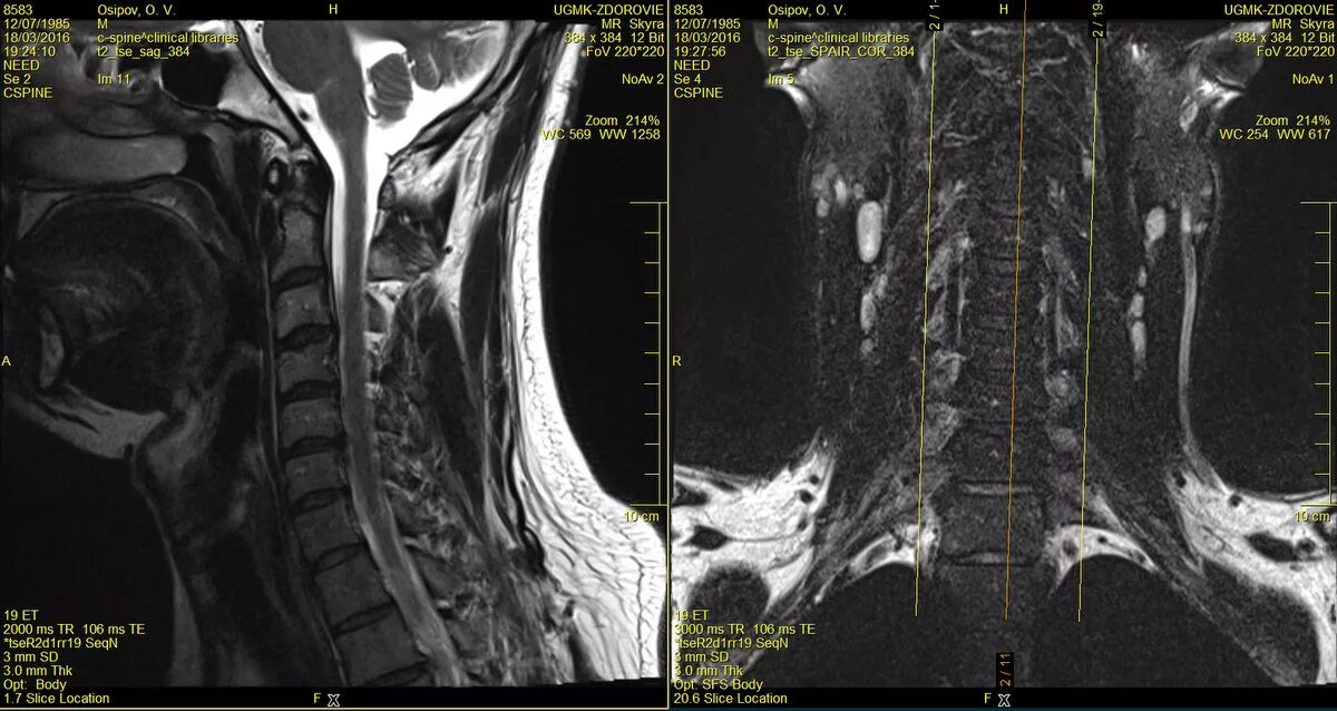 Мрт шейного отдела норма. Магнитно-резонансная томография.грыжи шейного отдела. Щитовидка на мрт шейного отдела позвоночника. Мрт шеи сбоку. Мрт шейного отдела позвоночника по времени