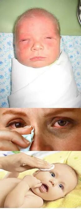 Массаж глаза у новорожденного. Зондирование слезного канала у детей. Конъюнктивит и дакриоцистит новорожденных. Врожденный дакриоцистит. Непроходимость слезного канала дакриоцистит.
