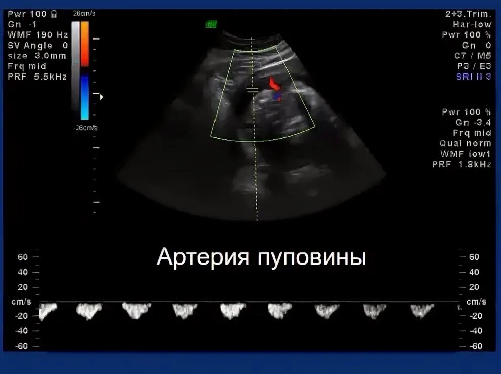 Артерия пуповины что это. Артерия пуповины что это. Обвитие пуповины вокруг шеи. Артерия пуповины что это. Артерия пуповины что это.