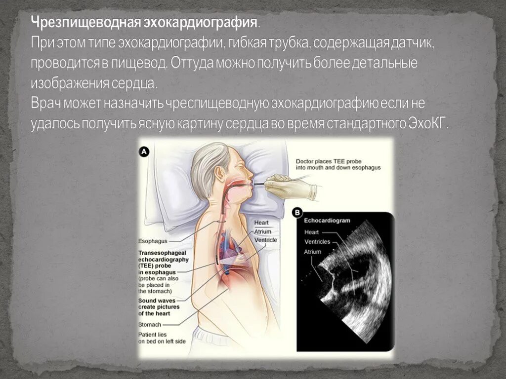 Через пищевод. Чрезпищеводная эхокардиография. Чреспищеводная ЭХОКГ датчик. Эхокардиография сердца через пищевод. Чреспищеводная эхокардиография (ЧПЭХОКГ).