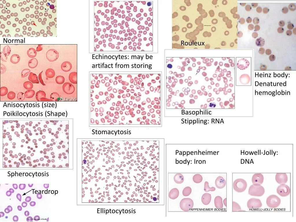 Тельца гейнца. Тельца Жолли пойкилоцитоз анизоцитоз. Анизоцитоз пойкилоцитоз тельца Жолли кольца Кебота. Эритроциты с тельцами Жолли. Тельца Паппенгеймера в эритроцитах.