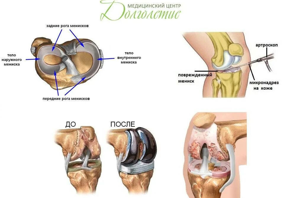 Мениск коленного сустава лечение в домашних. Мениски коленного сустава анатомия разрыв. Разрыв заднего мениска коленного сустава. Наружный латеральный мениск. Разрыв внутреннего мениска коленного.