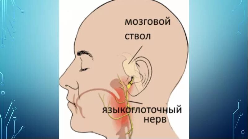 Поражение языкоглоточного нерва. Невралгия языкоглоточного нерва. Невропатия и невралгия языкоглоточного нерва. Языкоглоточный нерв невралгия. Тройничный и языкоглоточный нерв.