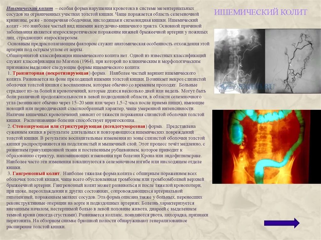 Ишемический колит патанатомия. Ишемический колит классификация. Ишемический колит и язвенный колит. Симптоматика ишемического колита. Колит слабость