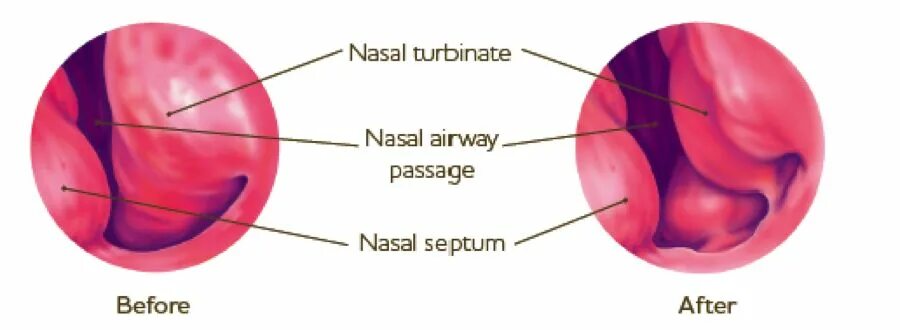 Подслизистой вазотомии нижних раковин. Каутеризация нижних носовых раковин. Увеличенные носовые раковины. Нормальные носовые раковины.