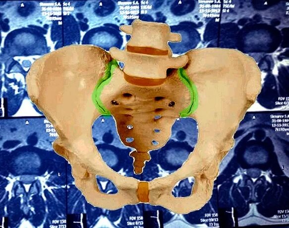 Доступы к крестцово подвздошному сочленению. Мрт КПС (крестцово-подвздошных сочленений). КПС сустав крестцово-подвздошный. Мрткресцово подвздошных сочленений. Сакроилеит крестцово-подвздошного.