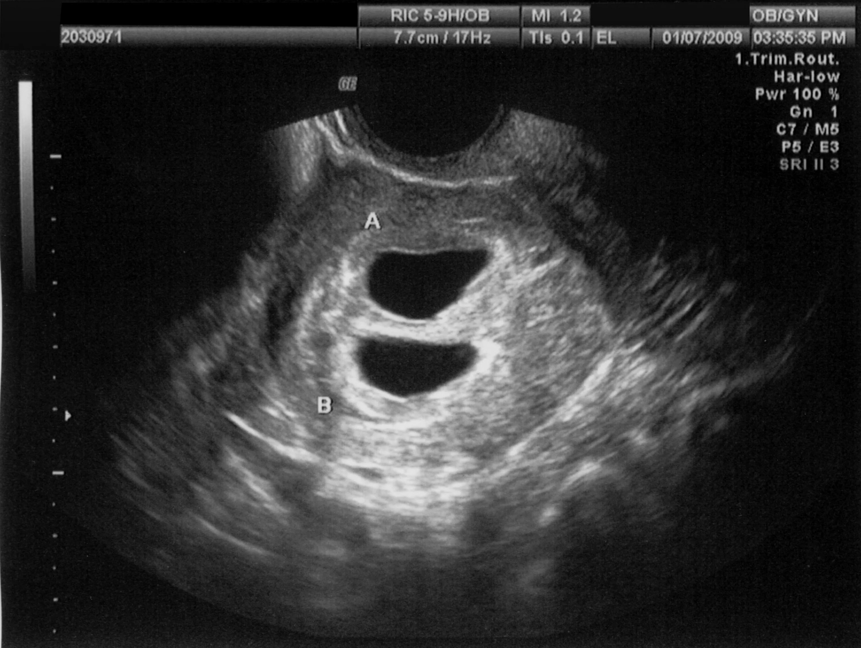 УЗИ беременность 2 плодных яйца. Снимок УЗИ двойни на 30 неделе беременности. УЗИ двойни на 5 неделе беременности фото. 2 недели видно на узи