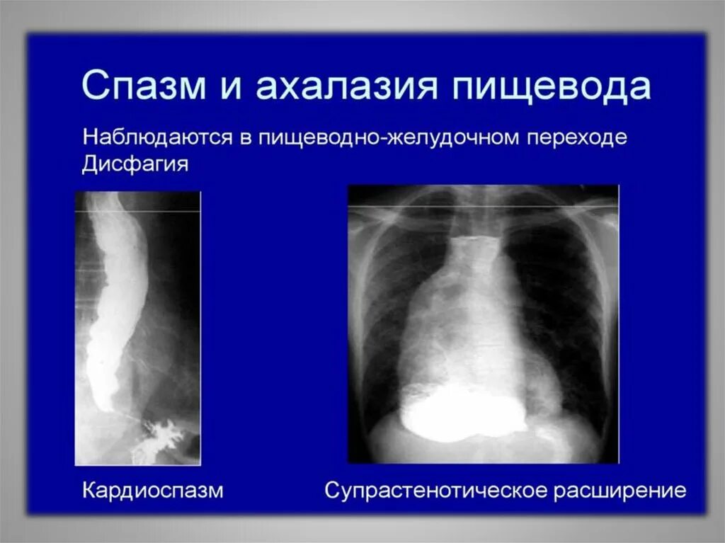 Ахалазия пищевода рентген. Рентген халащия пищевода. Ахалазия пищевода рентгенодиагностика. Ахалазия пищеводно-желудочного перехода. Халазия пищевода