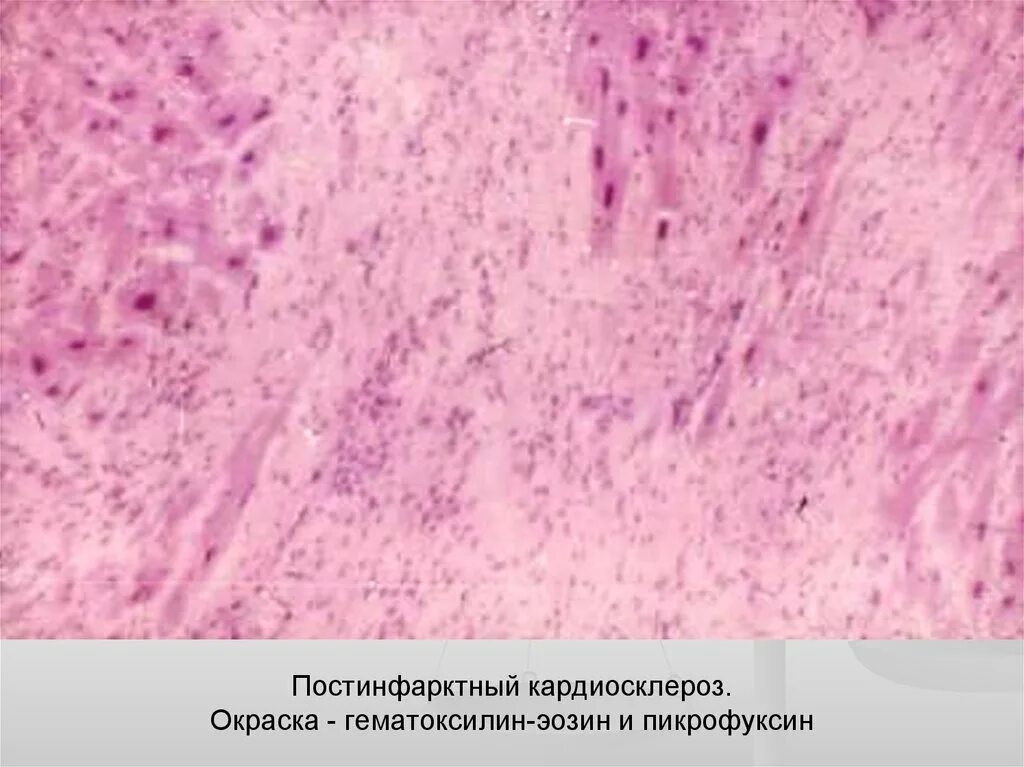 Диффузный мелкоочаговый. Постинфарктный кардиосклероз патанатомия микропрепарат. Постинфарктный кардиосклероз макропрепарат. Постинфарктный кардиосклероз патанатомия. Крупноочаговый постинфарктный кардиосклероз.