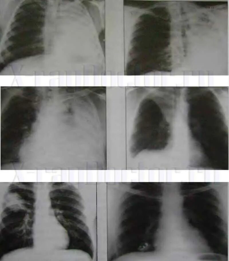 Тотальное затемнение рентгенограмма. Затемнение на снимке легких. Затемнение легкого на рентгене. Затемнение в лёгких на рентгене. Черные точки на легких