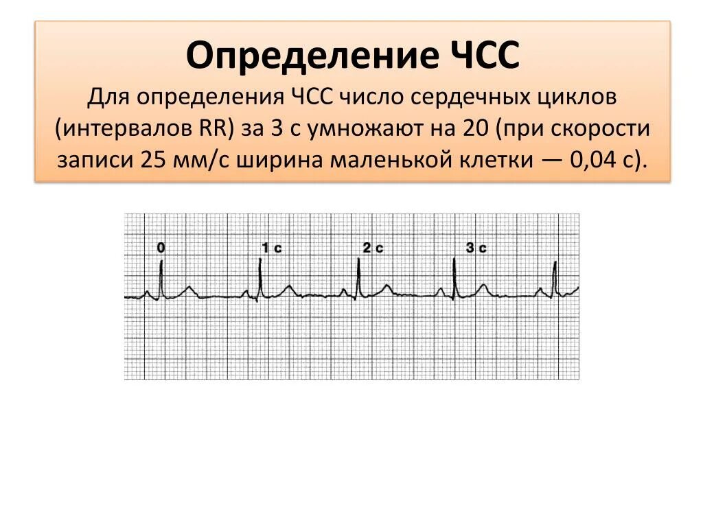 Как узнать сердцебиение. Формула ЧСС по ЭКГ 25 мм. ЧСС по ЭКГ 50 мм/с. Подсчет ЧСС на ЭКГ 50 мм/с. Частота сердечных сокращений по ЭКГ формула.