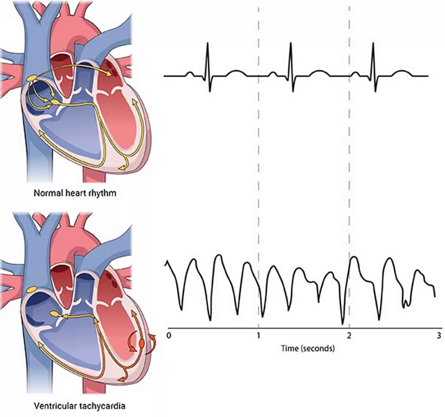 Сердце учащенное сердцебиение. Желудочковые нарушения ритма тахикардия. Нарушение ритма желудочка сердца. Аритмия сердца. Сердечный ритм схема.