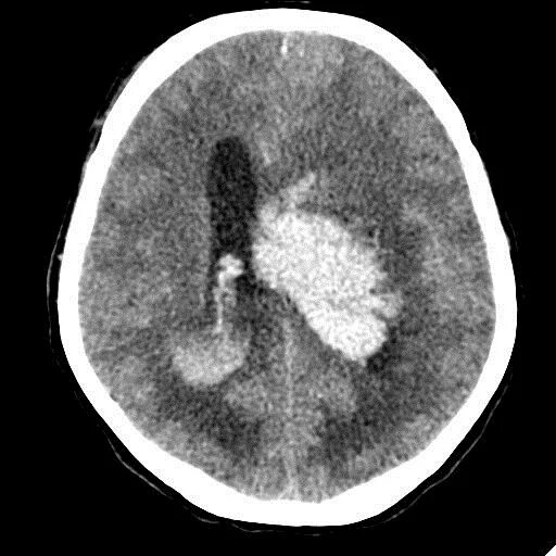 Кт головного мозга кровоизлияние. Диапедезное кровоизлияние на кт. Кровоизлияние в опухоль головного мозга на кт. Кровоизлияние в опухоль мозга кт. Кровоизлияние в желудочки