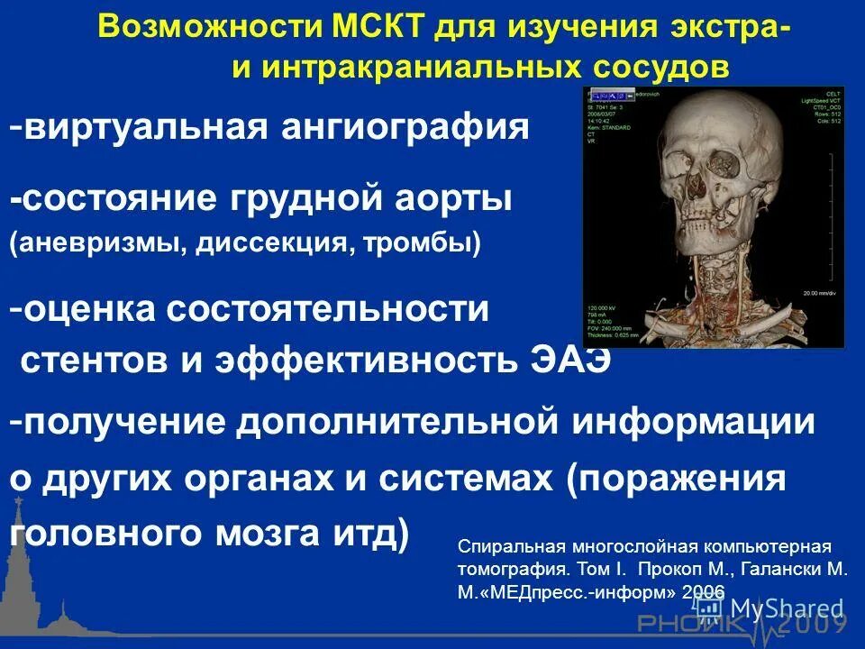 Интракраниальные артерии головного мозга