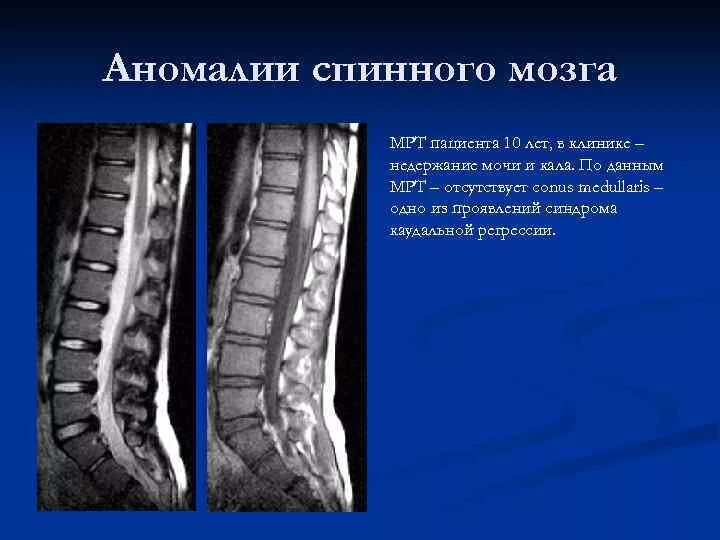 Гидромиелия сирингомиелия. Мрт спинного мозга и позвоночника. Арахноидит конского хвоста на мрт. Арахноидит спинного мозга мрт.