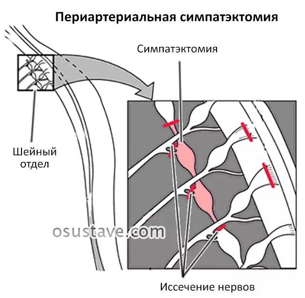 Симпатэктомия цена. Поясничная симпатэктомия ход операции. Операция Лериша периартериальная симпатэктомия. Люмбальная симпатэктомия. Торакоскопическая грудная симпатэктомия.