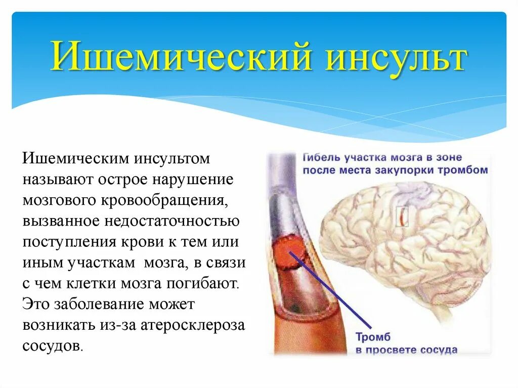 Что такое ишемический инсульт головного мозга. Мришемического и нсульта. ОНМК ишемический инсульт.