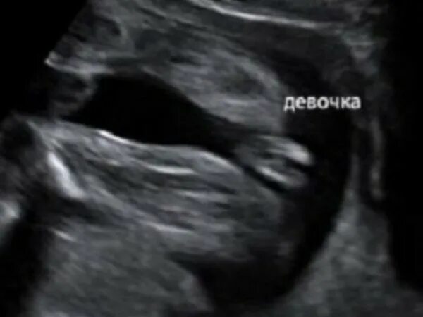 Мальчик и девочка на УЗИ В 12 недель беременности. УЗИ на 19 неделе беременности пол ребенка девочка. УЗИ 19 недель беременности девочка.