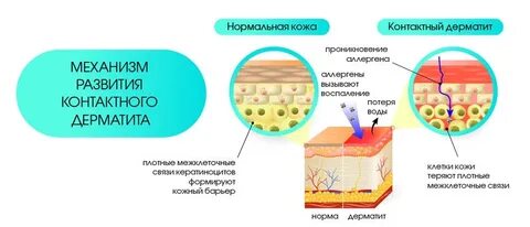 К дерматитам относятся