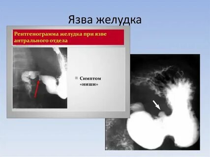 Перфорация язвы двенадцатиперстной