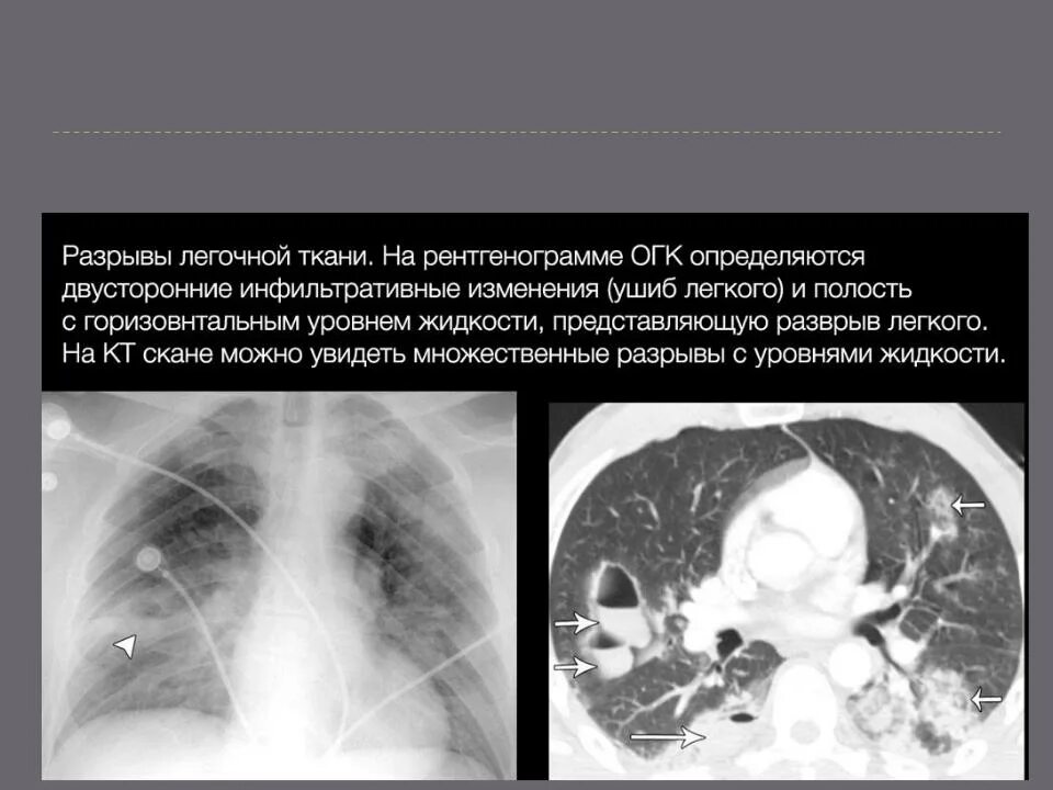 Внутрилегочная гематома на рентгене. Внутрилегочные гематомы кт. Нагноение внутрилегочной гематомы кт.