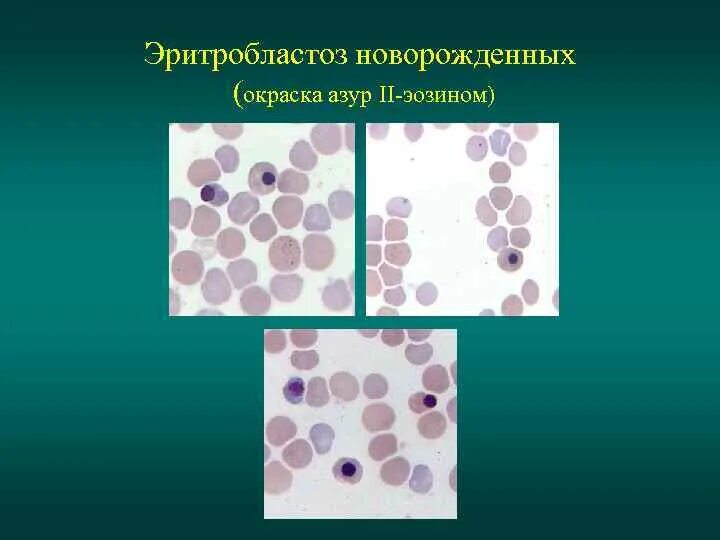 Окраска азур эозином. Срез красного костного мозга азур 2 эозин. Кровь препарат гистология. Окраска азур эозином. Азур эозин методика окраски.