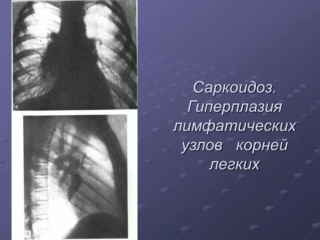 Лимфоузлы гиперплазированы. Медиастинально-легочный саркоидоз. Гиперплазия внутригрудных лимфоузлов что это такое. Саркоидоз лимфоузлов легких. Саркоидоз легких рентген.