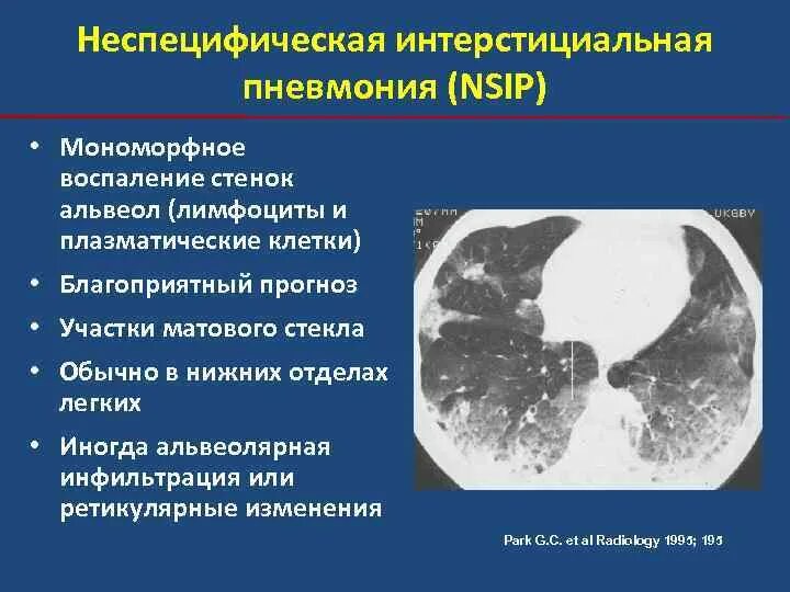 Что означает изменения в легких. Неспецифическая интерстициальная пневмония кт. Кт картина неспецифической интерстициальной пневмонии. Идиопатическая интерстициальная пневмония кт. Острая интерстициальная пневмония кт.